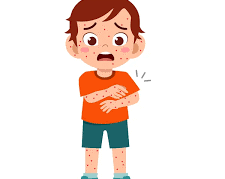 Kasus Campak Meningkat, Kemenkes Keluarkan Surat Edaran Kewaspadaan untuk Tenaga Kesehatan